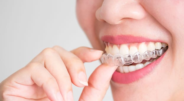 Female patient puts in her Invisalign® aligner from Perspective Dental