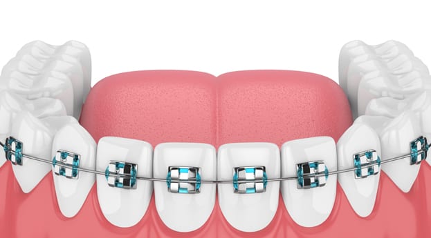 Choose Perspective Dental For Traditional Metal Braces