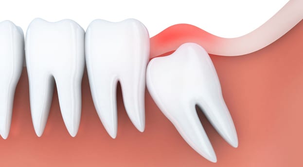 Top Reasons To Visit Perspective Dental For Wisdom Teeth Removal