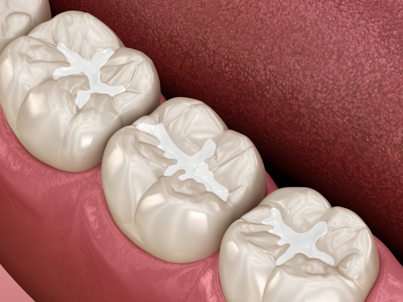 Dental sealants applied to molars at Perspective Dental