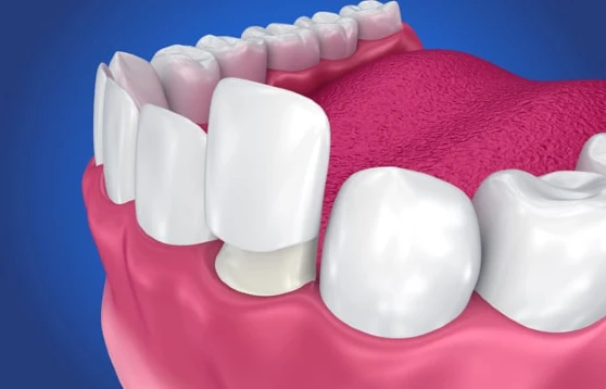 Perspective Dental's Porcelain Crowns for front teeth