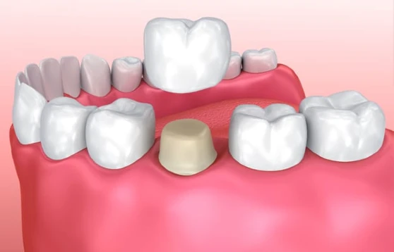 Porcelain Crown for molar at Perspective Dental in Austin, TX